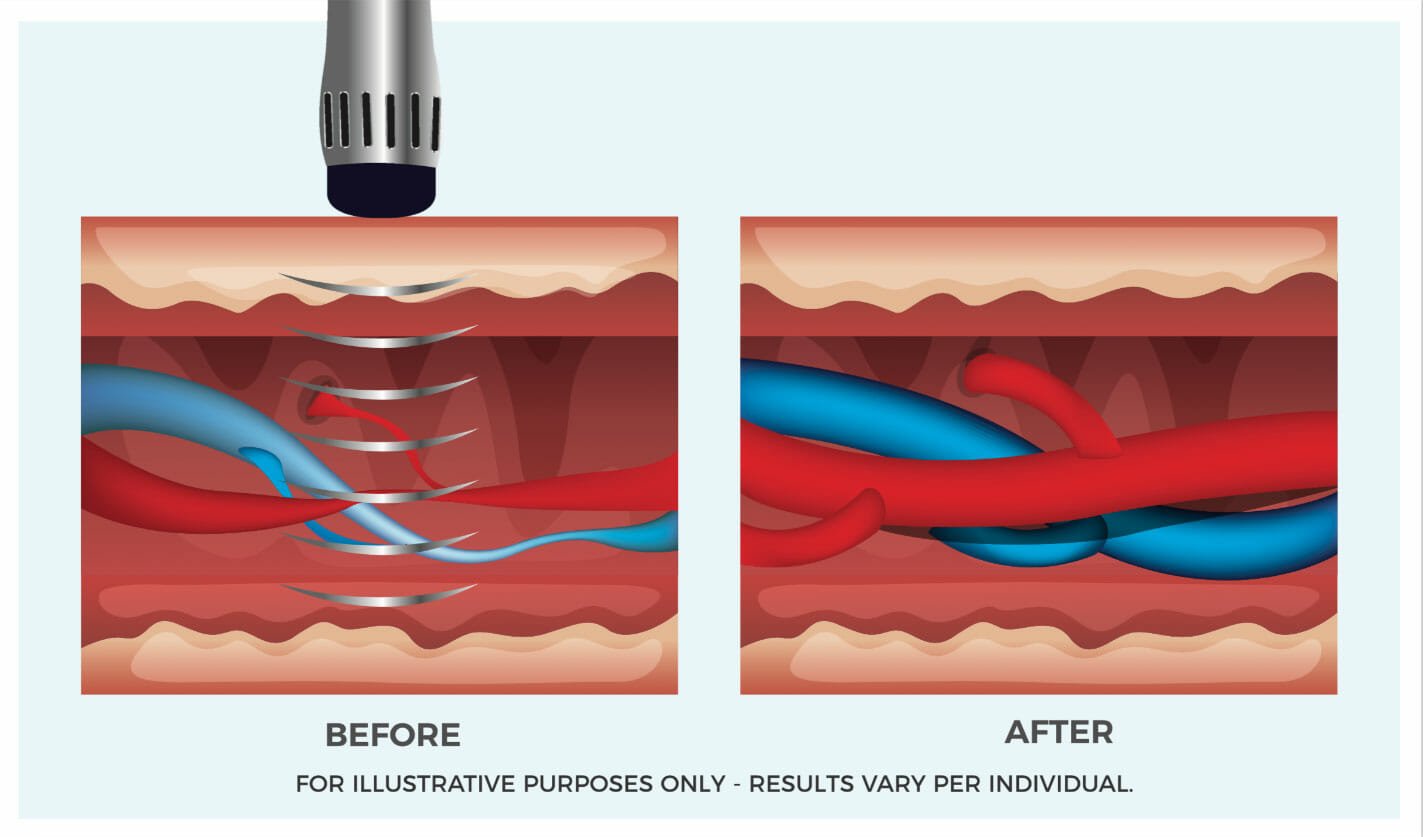 Erectile Dysfunction Shock Wave Therapy Peninsula 1 Hrt For Men